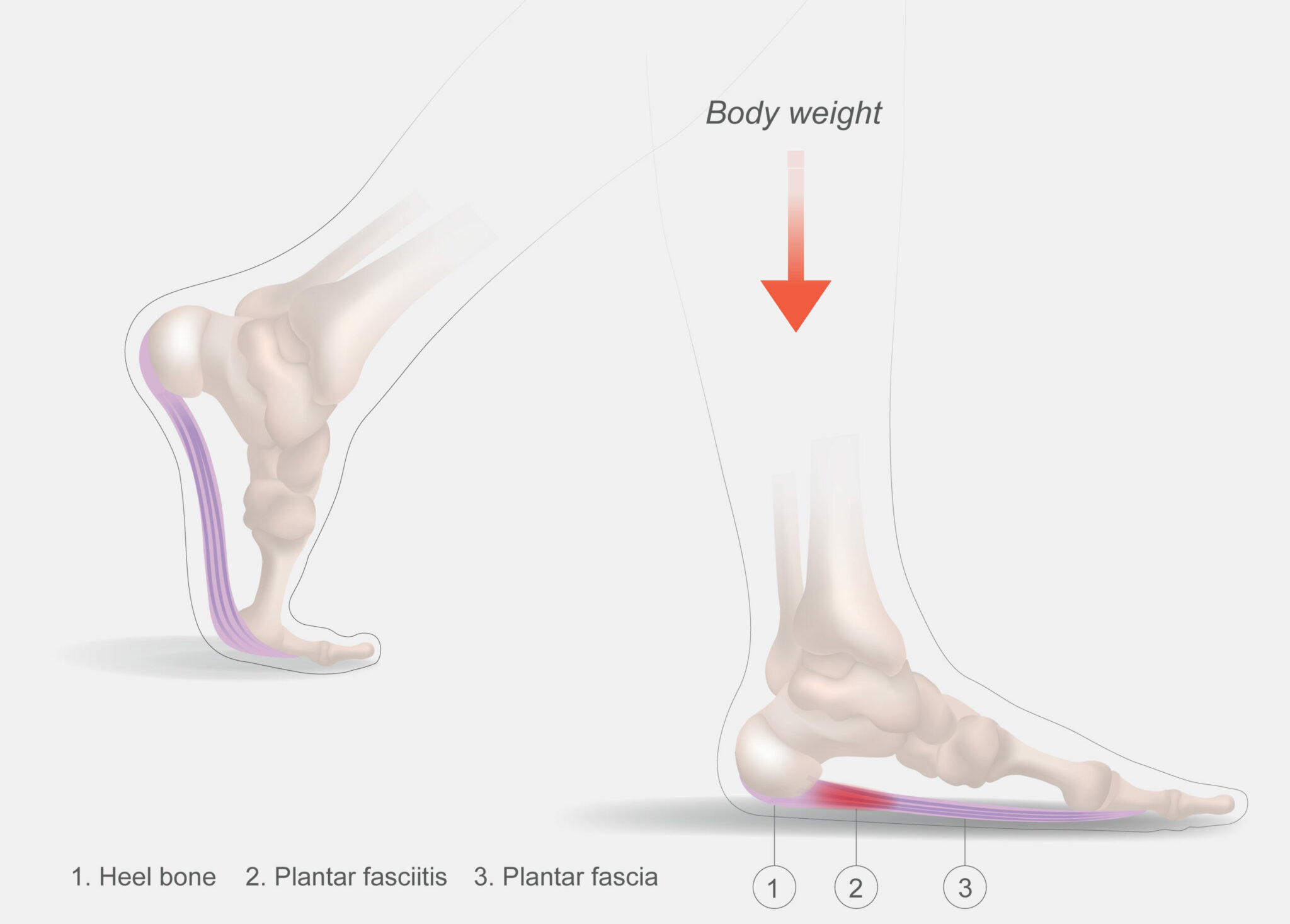 Plantar Fasciitis in Sugar Land, Texas A Comprehensive