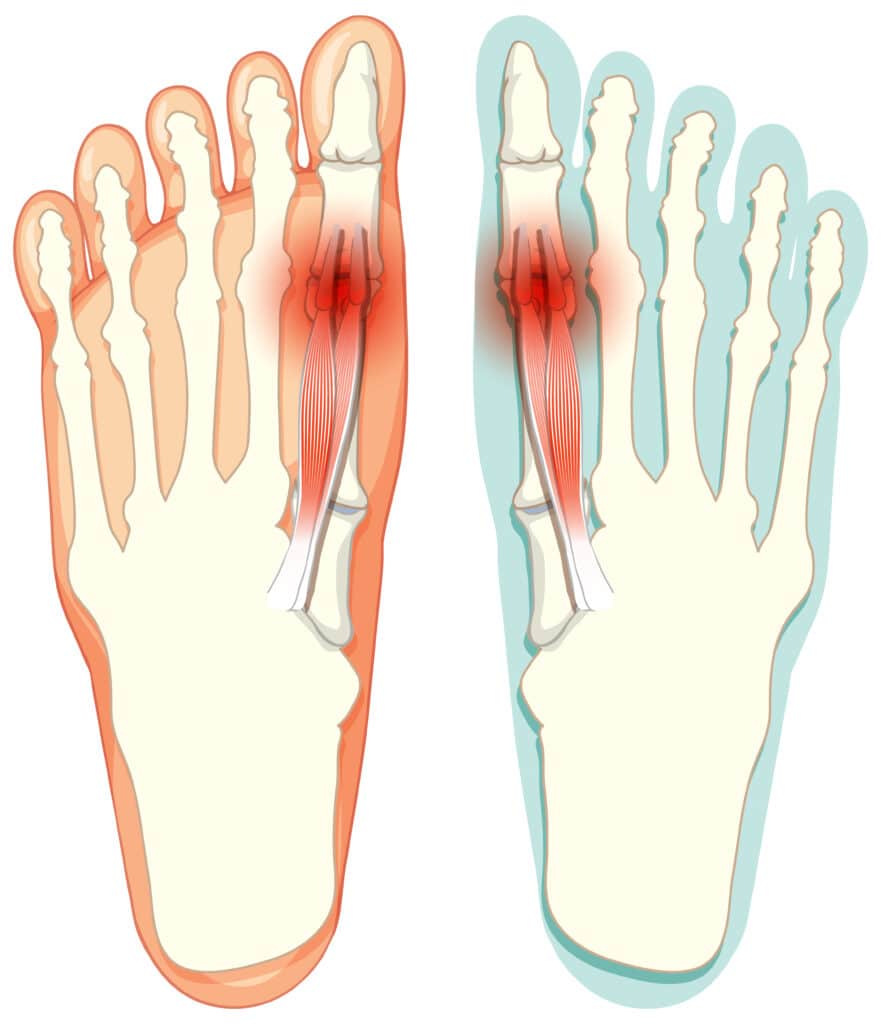 Overlapping Toes Caused by Bunions | Vargas Foot Specialists