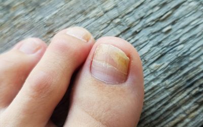 Toenail Fungus Treatment in Sugar Land, Texas: Discover the Benefits of Lunula Laser Therapy