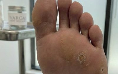 Plantar Warts Won’t Go Away? Here’s How Swift® Therapy Can Help
