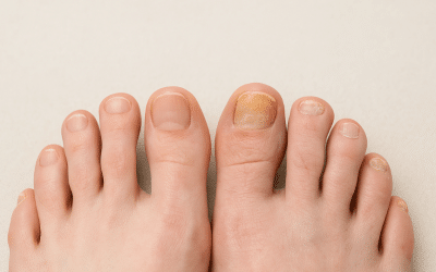 Why Are My Toenails Yellow? Common Causes and Treatment Options