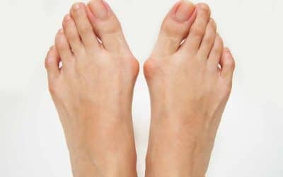 Bunion Treatment in Sugar Land, Texas: Don’t Let Foot Pain Slow You Down