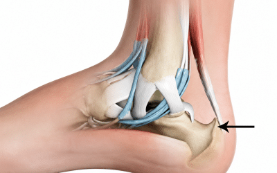 What Is Haglund’s Deformity? The Condition That Has Football Players Cutting Holes in Their Cleats
