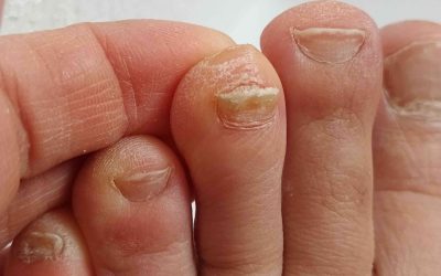Why Are My Toenails Thick? Causes, Treatment, and When to See a Podiatrist